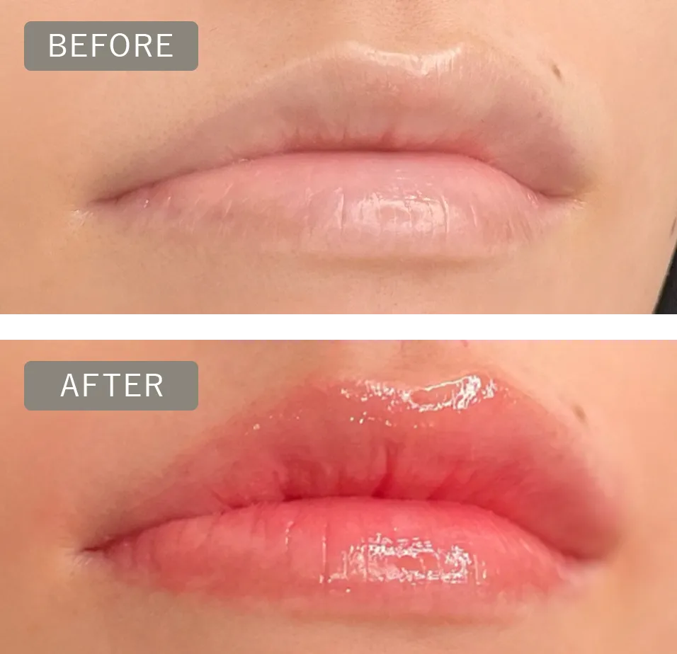 唇のbeforeとafterの写真